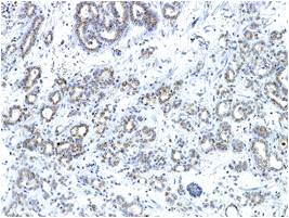 抗コア2 GnT1, モノクローナル抗体を使用した前立腺癌組織に対する免疫染色像