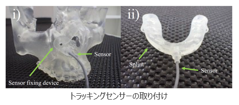 顎矯正手術用ナビゲーションシステム