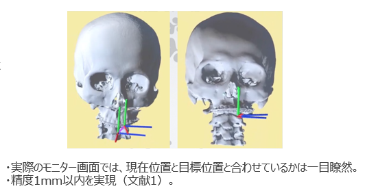 顎矯正手術用ナビゲーションシステム