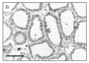 Investigation method of breast disease